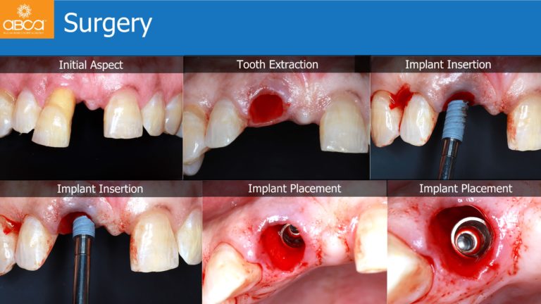 Immediate Loading in the Aesthetic Zone of Tooth 